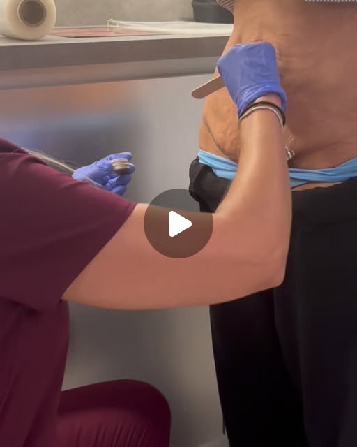 Fractional CO2 laser body treatment featured in an Instagram post