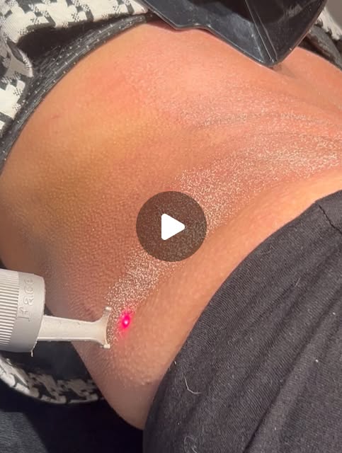 CO2 laser resurfacing treatment featured in an Instagram post
