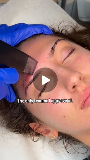 Microneedling treatment featured in an Instagram reel