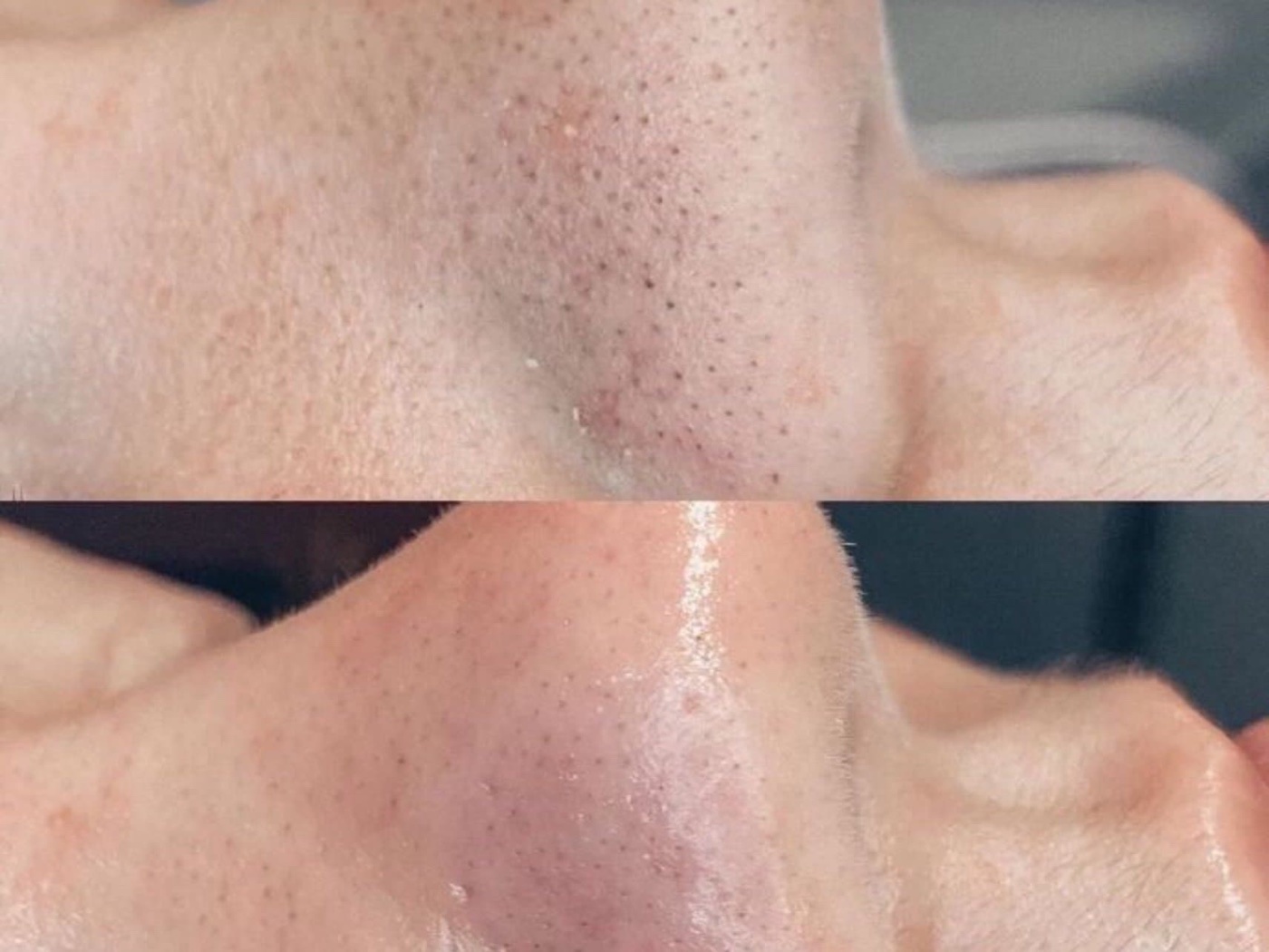 Before-and-after close-up of clarified facial skin