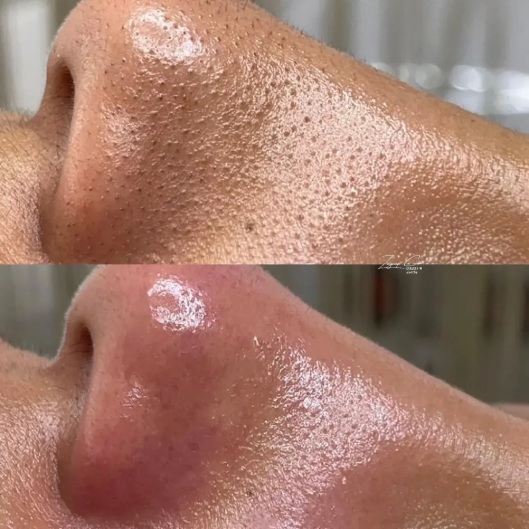 Close-up before-and-after view of skin around the nose after a HydraGlow treatment
