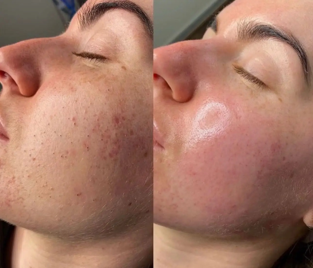 Side-by-side facial skin result from a HydraGlow treatment