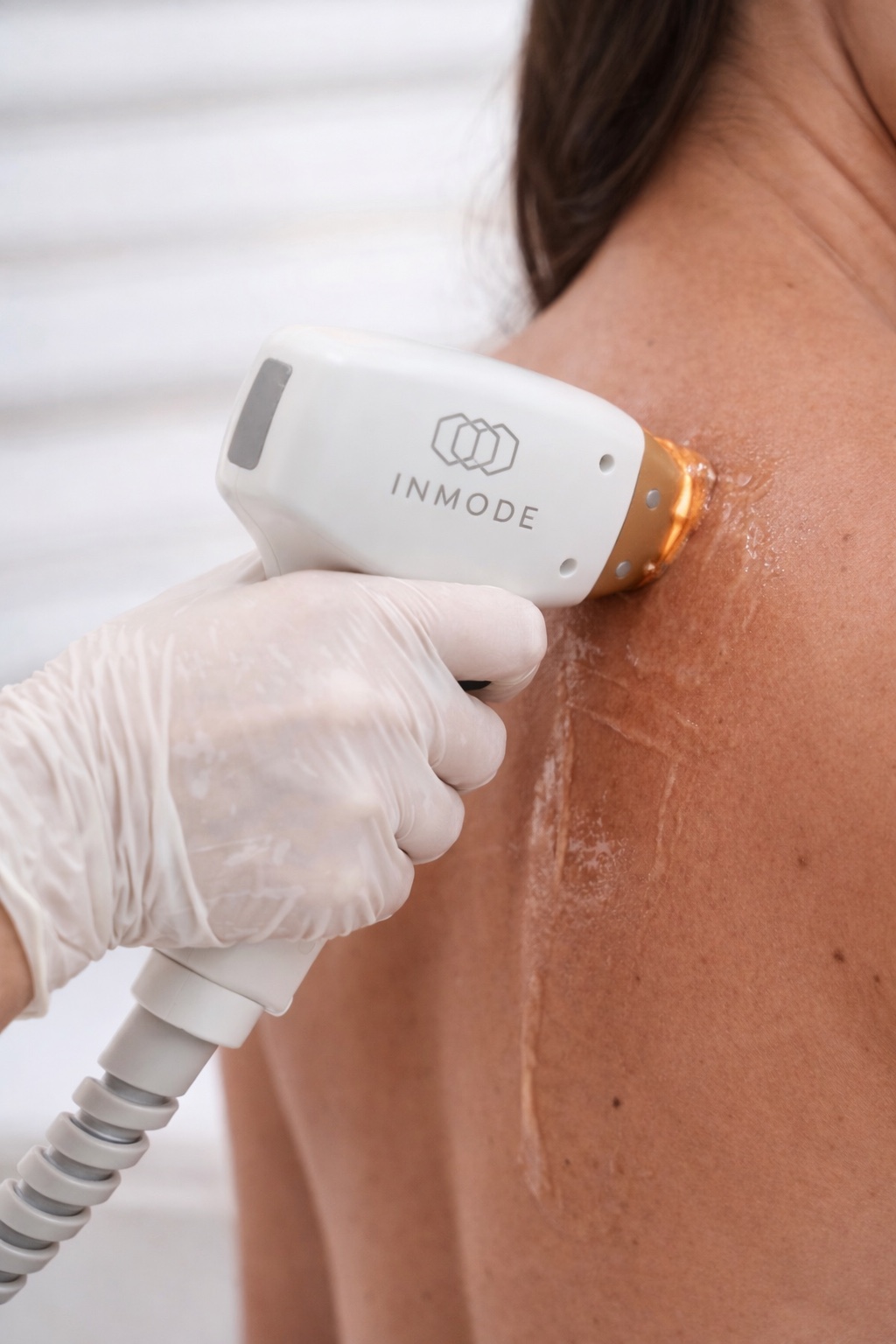 InMode laser treatment being performed on a client