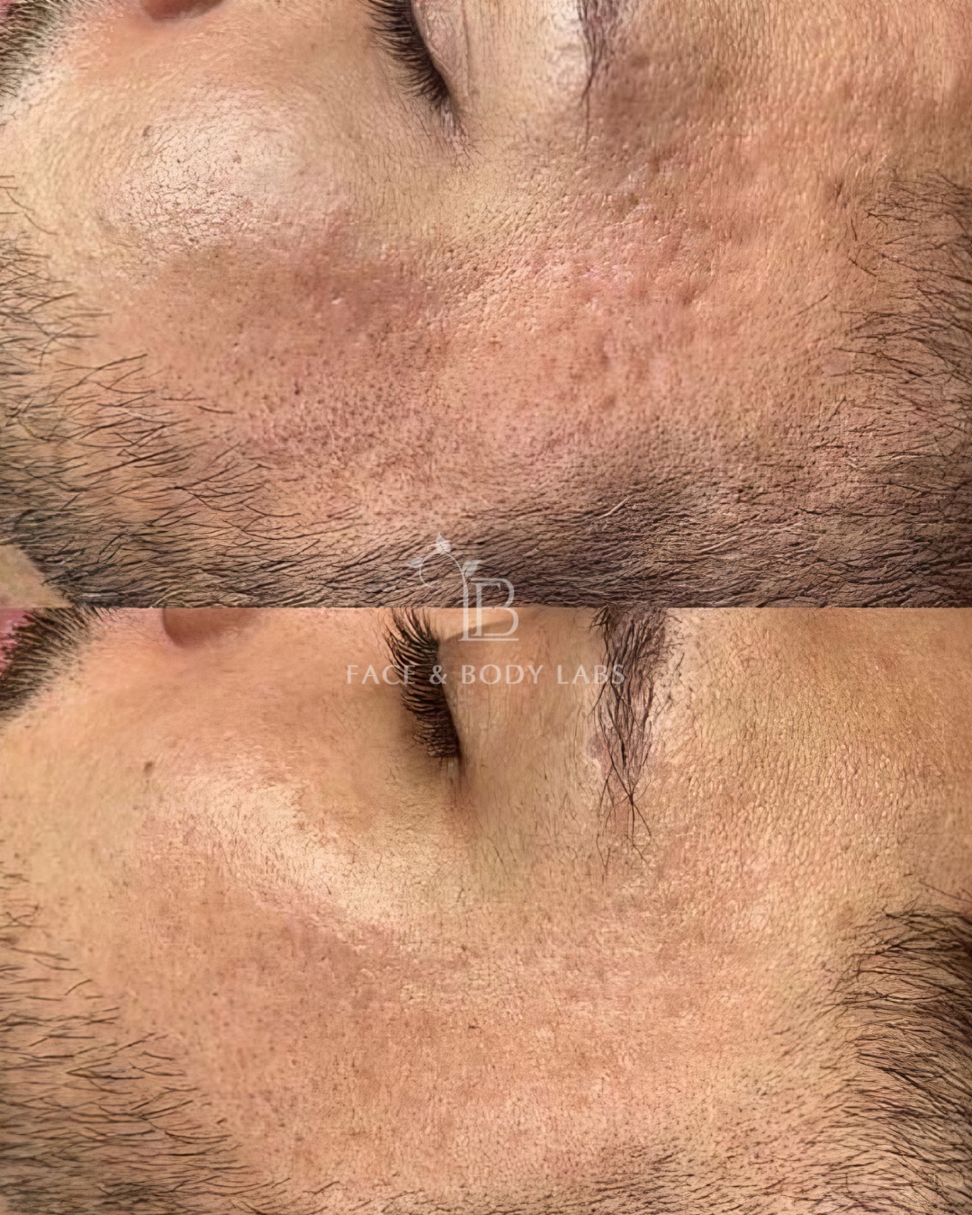 Before-and-after microneedling result showing facial texture
