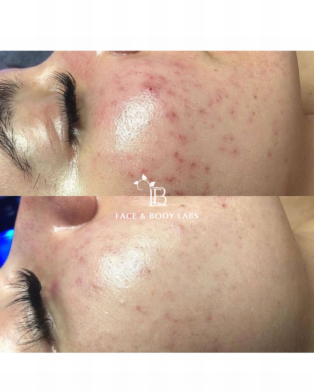 Before-and-after microneedling result showing cheek texture