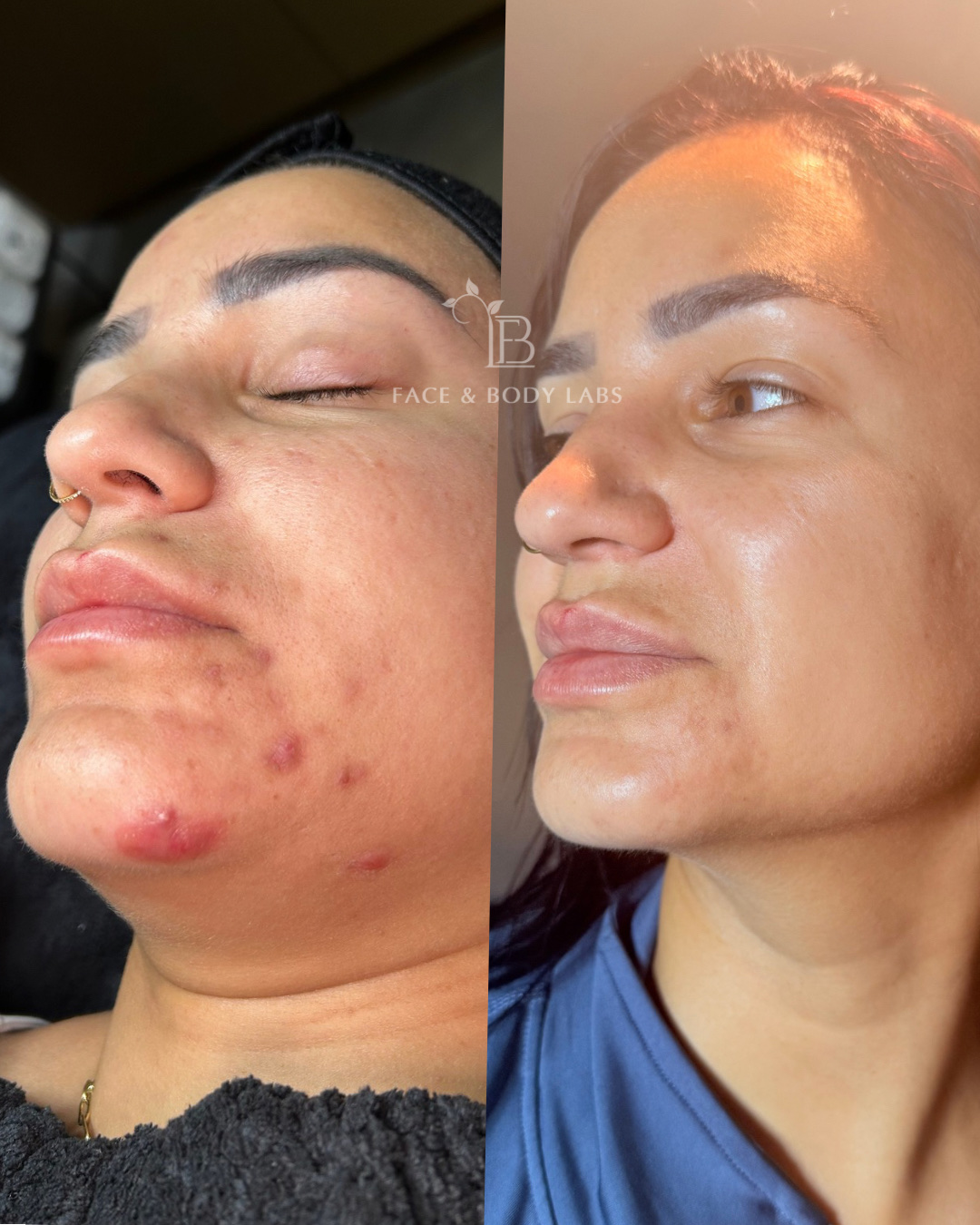 Before-and-after microneedling result showing visible skin progress
