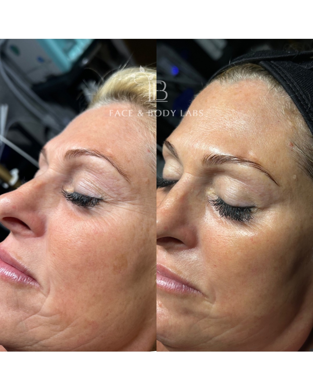 Before-and-after result shown for a Peptide Firming Facial