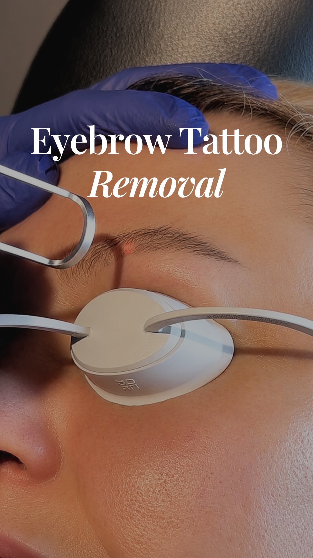 Eyebrow tattoo removal treatment in progress with protective eyewear