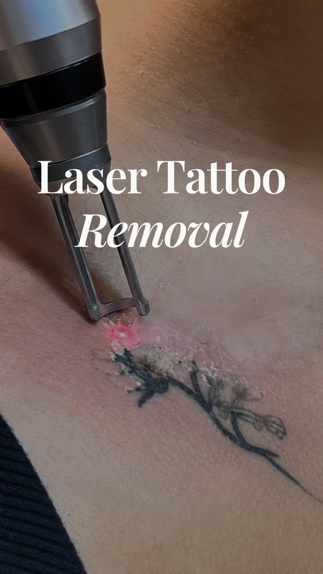 Laser tattoo removal treatment in progress on a body tattoo